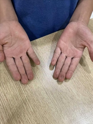 9歲小學(xué)生長(zhǎng)期拍煙卡，手部粗糙長(zhǎng)繭。受訪者供圖