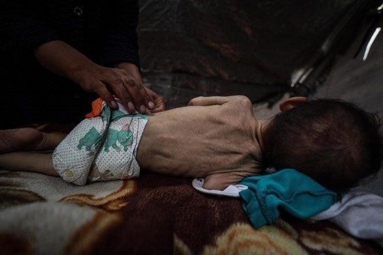 這是5月28日在加沙城西部一處臨時安置點拍攝的一名營養(yǎng)不良的嬰兒。新華社發(fā)（馬哈茂德·扎基攝）
